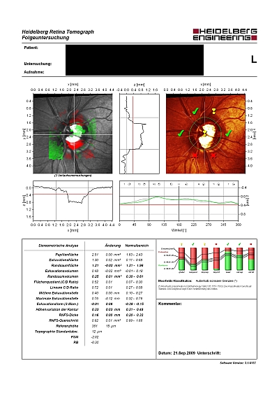 Eine Laser-Scanning-Aufnahme des gleichen Auges dokumentiert den Schwund des neuroretinalen Randsaums über einen Beobachtungszeitraum von 175 Monaten (rote Fläche unter und über der Papille).