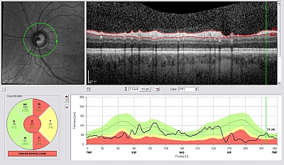 Vermessung der retinalen Nervenfaserschicht rund um die Papille. Dabei zeigt die dunkle Linie im Verhältnis zur grünen Fläche zur Schläfe hin und unten die Verdünnung der Schicht, die außerhalb der Norm liegt.