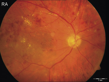 Nicht-proliferative diabetische Retinopathie