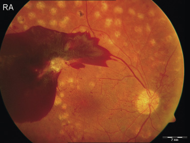 Proliferative diabetische Retinopathie mit Einblutung in den Glaskörper